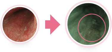 NBI(特殊光)で見ると… 早期の食道ガンが はっきりと見えます。