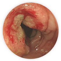 【写真】進行大腸がん 