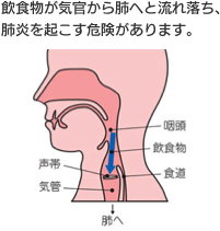 【写真】飲食物が気管から肺へと流れ落ち、肺炎を起こす危険があります。